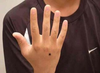 Nốt ruồi trên mu bàn tay