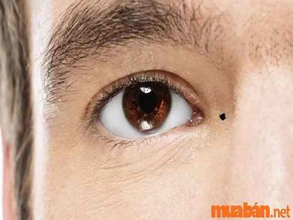 Nốt ruồi nơi hốc mắt