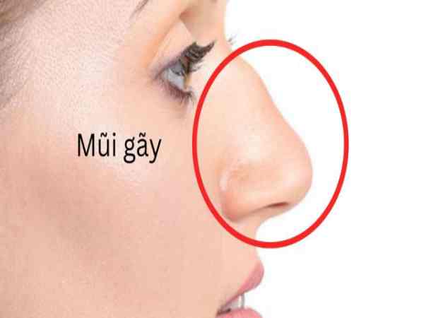 Xem tướng mũi gãy về sự nghiệp