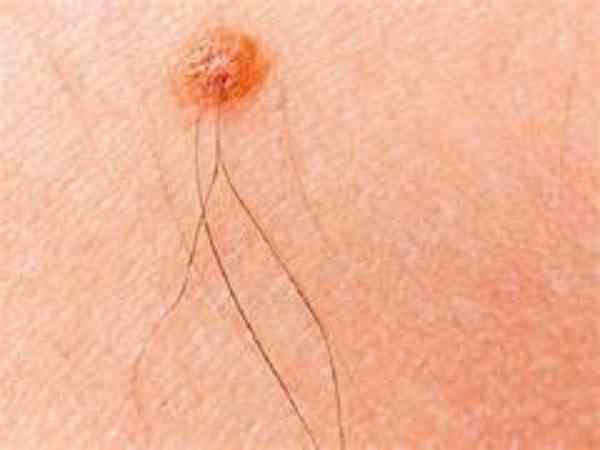 nốt ruồi có lông ở trên trán