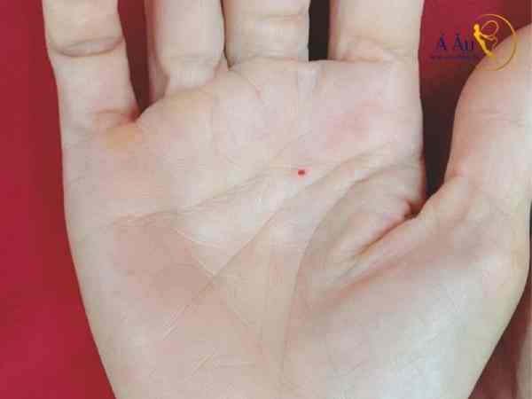 Nốt ruồi ở vị trí chỉ tay thứ hai