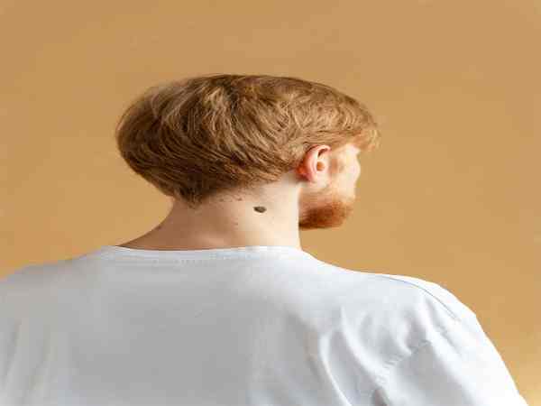 nốt ruồi sau gáy