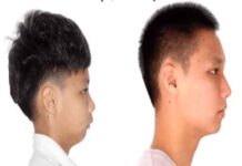 Tướng cằm lẹm là sao, ý nghĩa nam nữ sở hữu dáng cằm lẹm tướng cằm lẹm