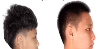 Tướng cằm lẹm là sao, ý nghĩa nam nữ sở hữu dáng cằm lẹm tướng cằm lẹm