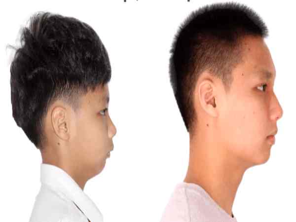 Đàn ông cằm lẹm tướng số ra sao? Đàn ông cằm lẹm tướng số ra sao?