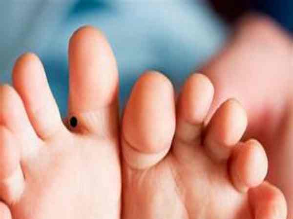 Nốt ruồi ở kẽ ngón chân điềm báo may mắn hay rủi ro?