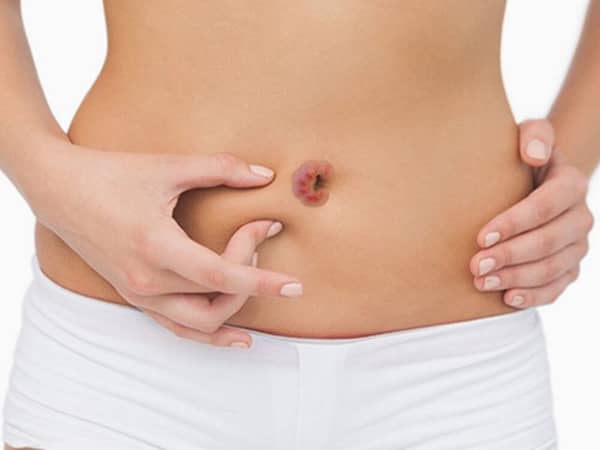 Ngứa rốn điềm báo gì ở nữ giới?