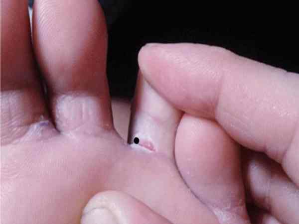 Ý nghĩa chung của nốt ruồi ở ngón chân áp út Ý nghĩa chung của nốt ruồi ở ngón chân áp út