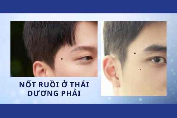 Nốt ruồi ở thái dương phải nam Nốt ruồi ở thái dương phải nam
