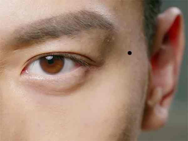 Vị trí nốt ruồi ở thái dương Vị trí nốt ruồi ở thái dương